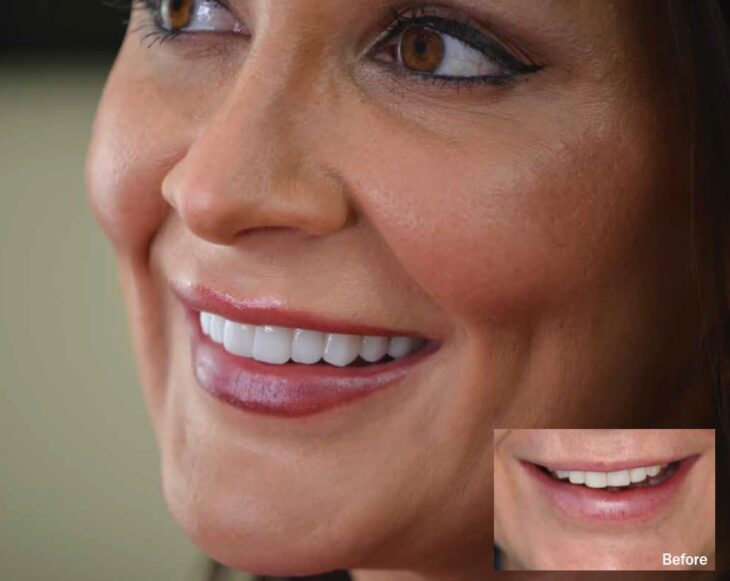 Image from How to get natural-looking veneers